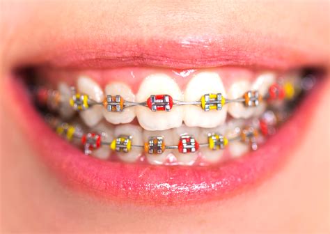 Fixed Orthodontic Braces .